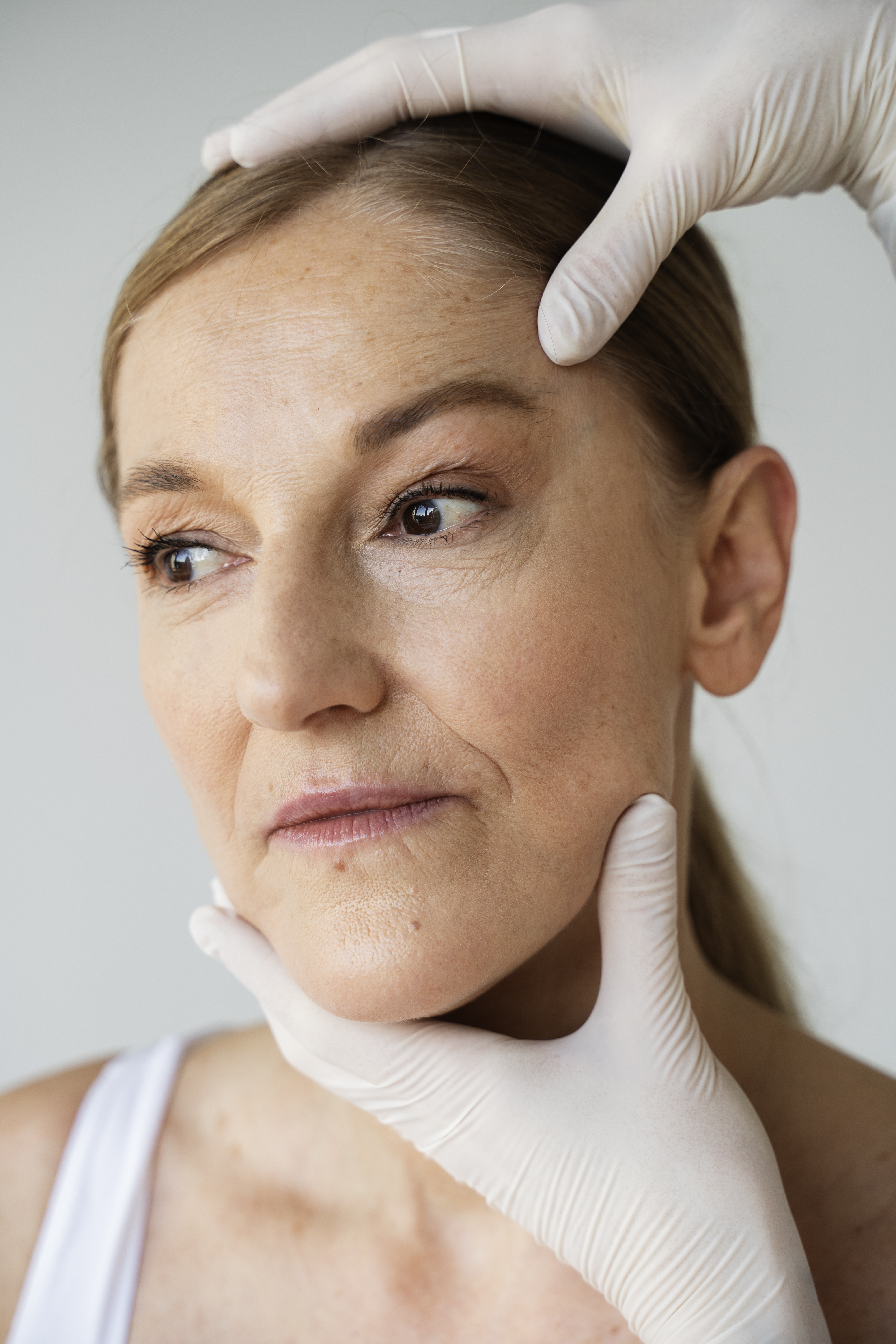 Melasma